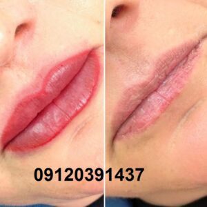 ریموو یا پاک کردن تتو قدیمی در صادقیه 5 ریموو تتو خط لب در صادقیه و آریاشهر تهران
