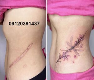 کاور جای بخیه با تتو 5 تتو روی جای بخیه قدیمی